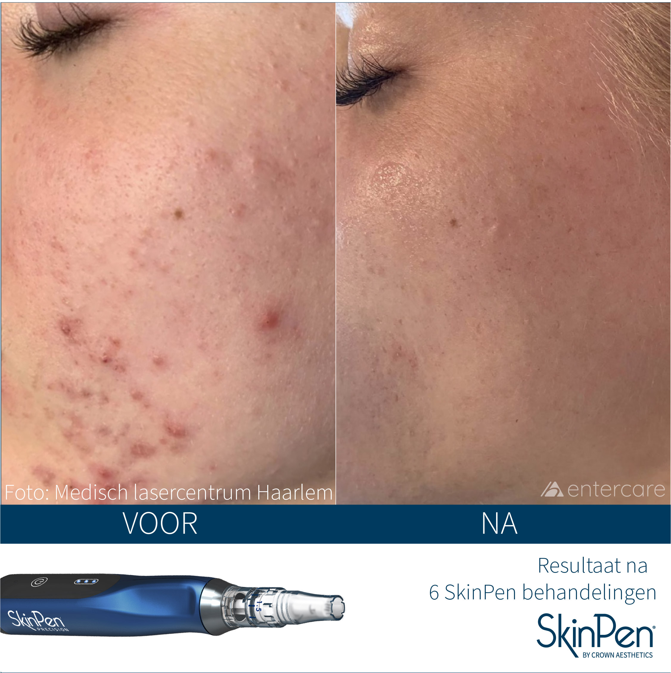 Skinpen resultaat